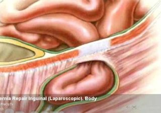 hernia surgery repair women โรคไส้เลื่อน ในผู้หญิง
